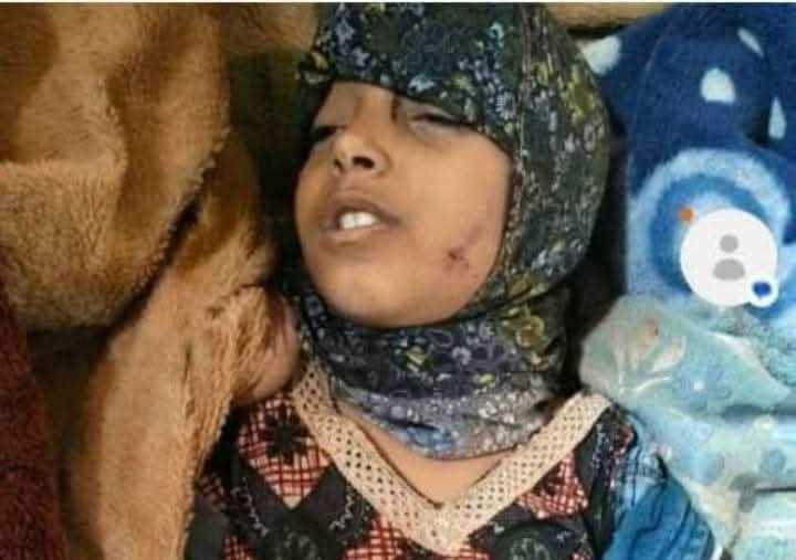 وفاة طفلة بعد تعرضها لضرب مبرح من والدها غربي إب