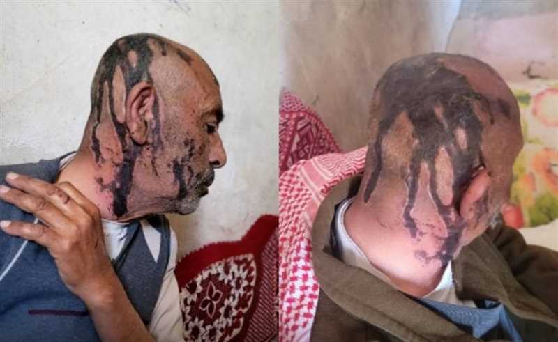 عمران..عناصر  حوثية حاولت قتل والدها والمليشيا ترفض القبض عليهم